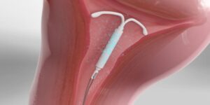 ڕێگاکانی ڕێگریکردن لە دووگیانی، ئامێری ناو منداڵدان (IUD)